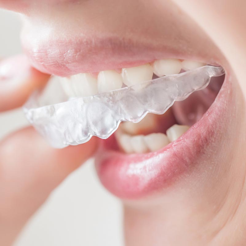 Invisalign London
